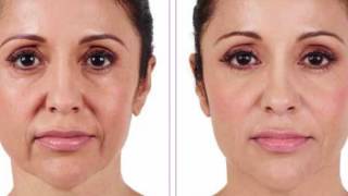 Botox vs Juvederm [upl. by Eltotsira]