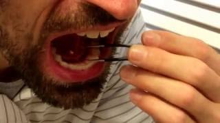 Removing my own salivary gland stone [upl. by Ruffi]