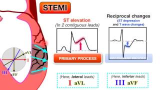 Ischemia 67  STEMI on ECG [upl. by Reviere]