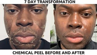 35 TCA Chemical Peel by Dr Edwin Williams for Wrinkles amp Sun Damage [upl. by Gievlos]