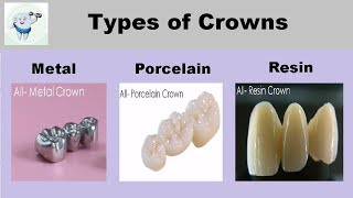 Types of Dental Caps  Crowns [upl. by Anuahsal]