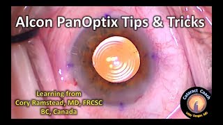 Alcon Panoptix trifocal IOL a review of new multifocal cataract lens [upl. by Brine940]