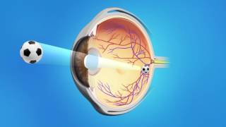 What to Know about the Light Adjustable Lens for Cataract Surgery with Dr Berdahl [upl. by Arodnahs]