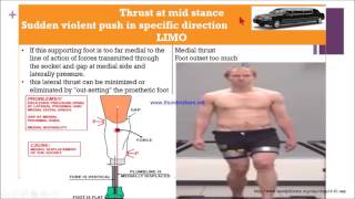 Transtibial gait deviation [upl. by Cummings]