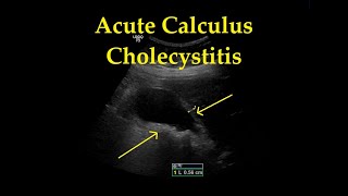 Gallstones  Cholelithiasis Symptoms Causes Diagnosis and Treatment [upl. by Grondin839]