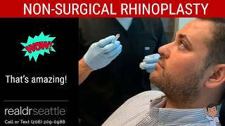 Non Surgical Nose Job  Non Surgical Rhinoplasty [upl. by Leontine]