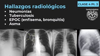 043  Neumonía TB EPOC Enfisema Bronquitis Bronquiectasias Asma [upl. by Modestine671]