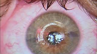 Keratoconus and C3R Corneal Cross Linking Treatment In Hindi [upl. by Aviv]