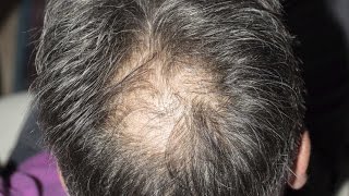 7 EASY Ways to Stop Hair Loss and KEEP Your Hair [upl. by Noivert926]