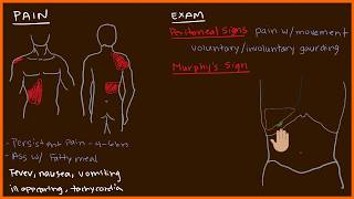 Acute Cholecystitis 23 [upl. by Kannan]