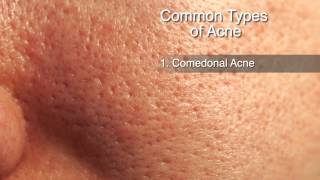 How to Treat Different Types of Acne [upl. by Ramo]