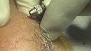 Permanent painless hair removal of chin electrolysis [upl. by Madison34]