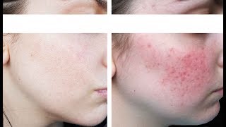 Tout sur ma Rosacée  Kératose pilaire  Session Laser  Dr Charbonneau [upl. by Nellak]