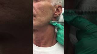 Juvederm Voluma Filler for the Jawline [upl. by Ramona]