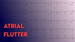 Atrial Flutter  EKG ECG Interpretation [upl. by Anastasius]