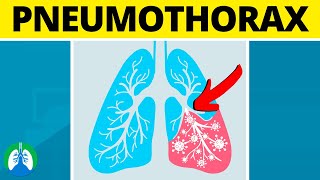 Pneumonia Causes Signs and Symptoms Diagnosis and Treatment [upl. by Annahsit]