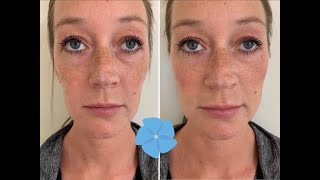 Juvederm Voluma Cheek Filler Treatment  Before  After  Nashville PA [upl. by Ardnuaet]