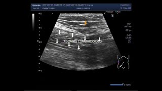 Intestinal worm Infestation by Ascaris lumbricoides [upl. by Trebleht]