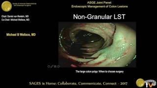 The large polyp When to choose EMR ESD surgery [upl. by Angle73]