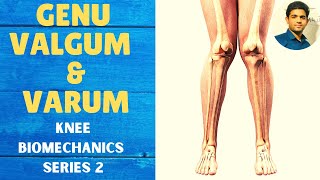 GENU VALGUM amp GENU VARUM  Knee Complex Biomechanics [upl. by Nap]