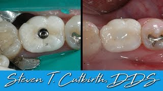 Securing Loose Implant Crown  Dental Minute with Steven T Cutbirth DDS [upl. by Enirok230]