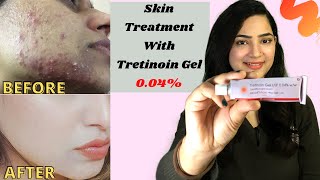 TRETINOIN Gel 004 Review Before And After Tretinoin Cream Review  RetinoA review myexperience [upl. by Oswell720]