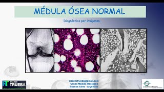 RESONANCIA MAGNETICA NORMAL DE LA MEDULA OSEA [upl. by Rramahs337]