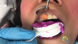 Cosmetic Dental Crown Procedure  All Ceramic Crown [upl. by Rambow]