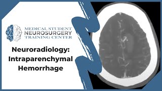 Neuroradiology Intraparenchymal Hemorrhage [upl. by Daney]