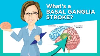 Basal Ganglia Stroke [upl. by Irianat881]