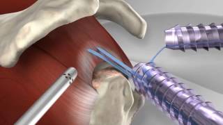 Rotator Cuff Repair Rehabilitation from start to finish [upl. by Cormier]